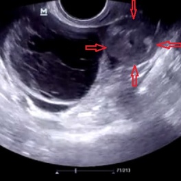 Cальпингоофорит (Аднексит) на УЗИ