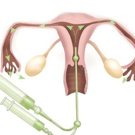Процедура гистеросальпингография (ГСГ)