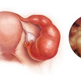 Левосторонний сальпингоофорит